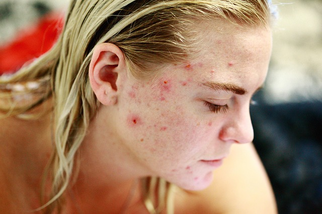 Natural home remedies for pimples – tea tree oil, aloe vera, and honey for clear skin